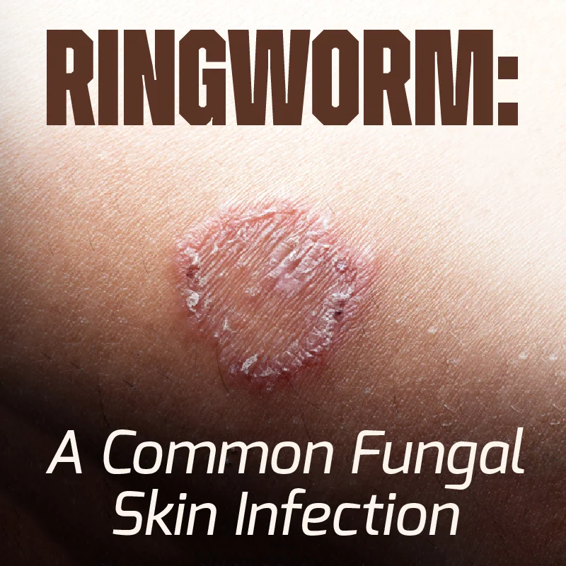 Buni Image Ringworm: A Common Fungal Skin Infection