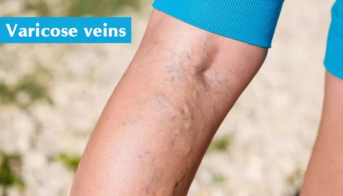 What are Varicose Veins? The Complete Guide
