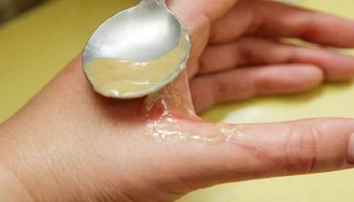 14 EasyHome Remedies for Burns!