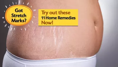 Got Stretch Marks? Try Out These 11 Home Remedies Now!