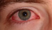 Conjunctivitis