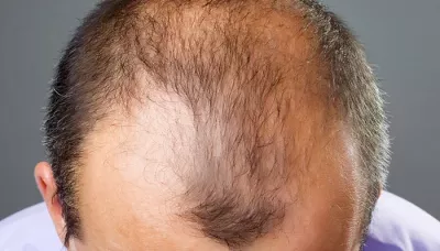 Alopecia & Bald Patches
