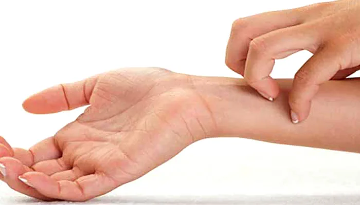 Rash/Itch/Urticaria/Hives